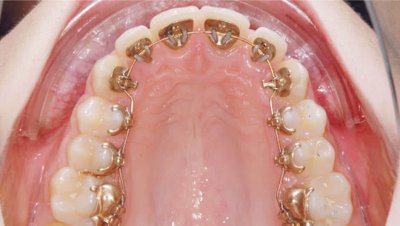 Lingual Ortodonti (Görünmeyen Diş Teli)