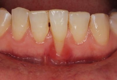 Diş Eti Hastalıkları ve Tedavileri Nelerdir? Diş Eti Çekilmesi Nasıl Tedavi Edilir?