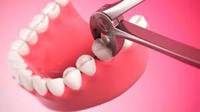 Ortodonti Tedavisinde Neden Diş Çekilir?