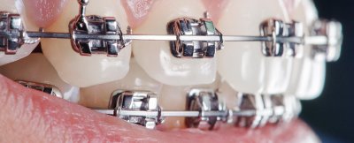 Ortodonti Tedavisi Kimlere Uygulanır, Kimlere Uygulanmaz?