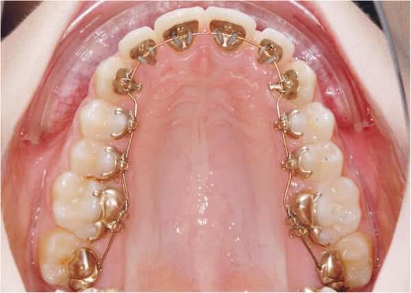 Lingual Ortodonti (Görünmeyen Diş Teli) Nedir?