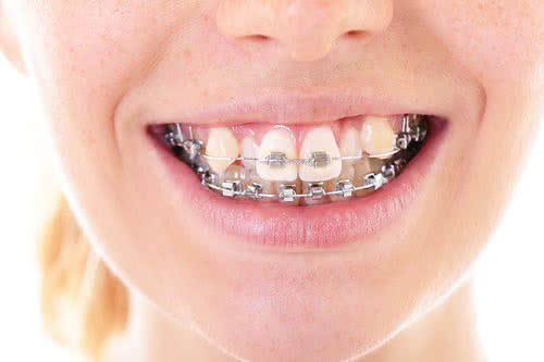 Ortodontik Tedavi Sonrası Dişlerim Eski Haline Döner mi?