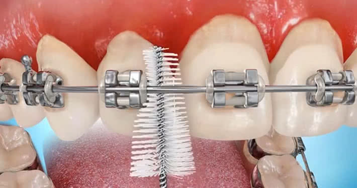 Ortodontik Tedavide Ağız Bakımı
