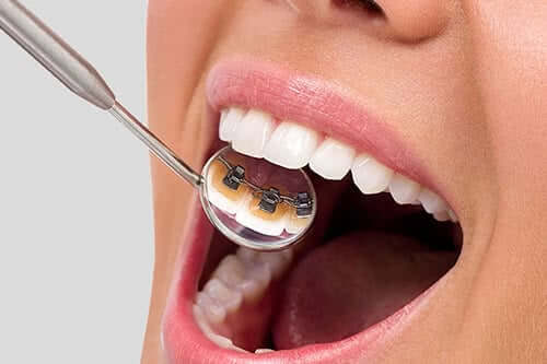 Ortodontik Tedavi Sonrasında Dikkat Edilmesi Gerekenler