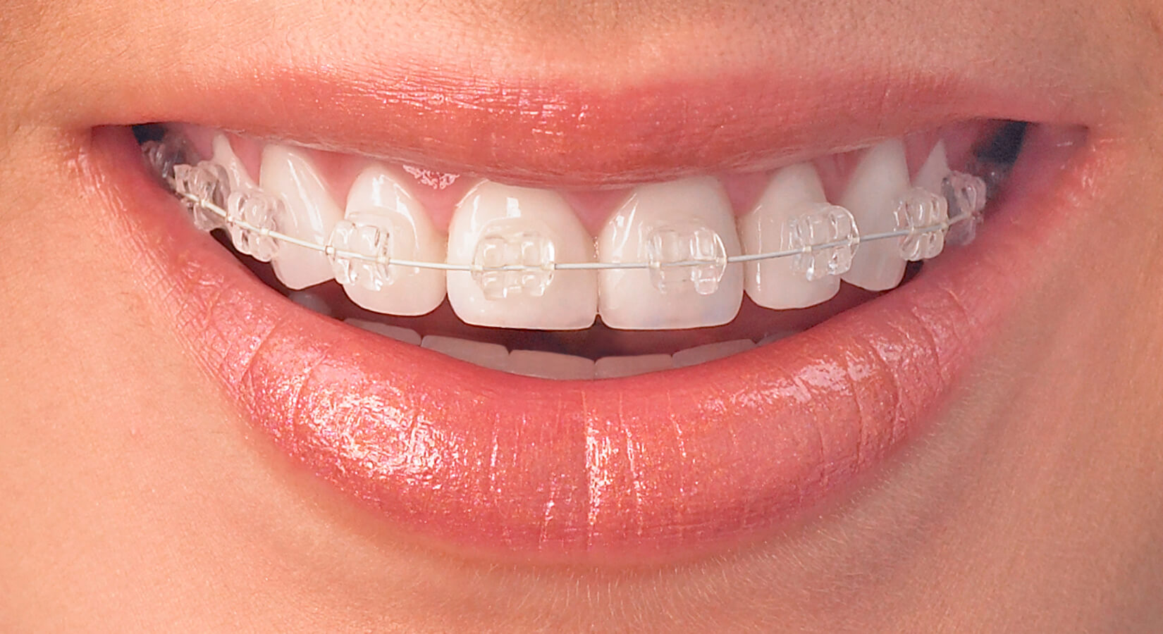 Ortodontik Tedaviye Başlarken
