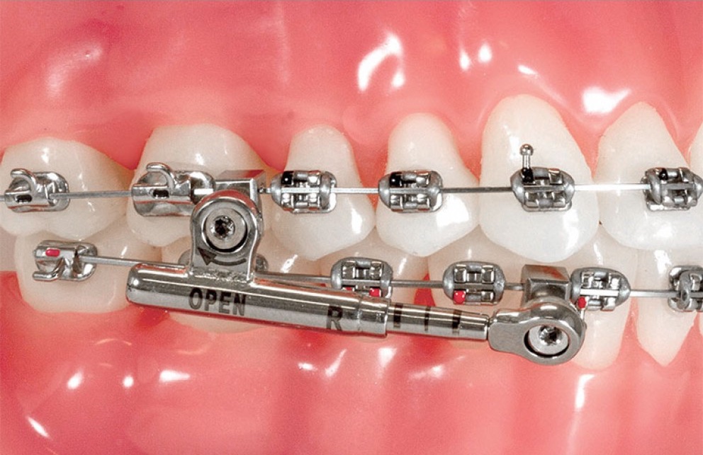 Ortodonti Tedavisinde Diş Teli Çeneyi Düzeltir Mi?
